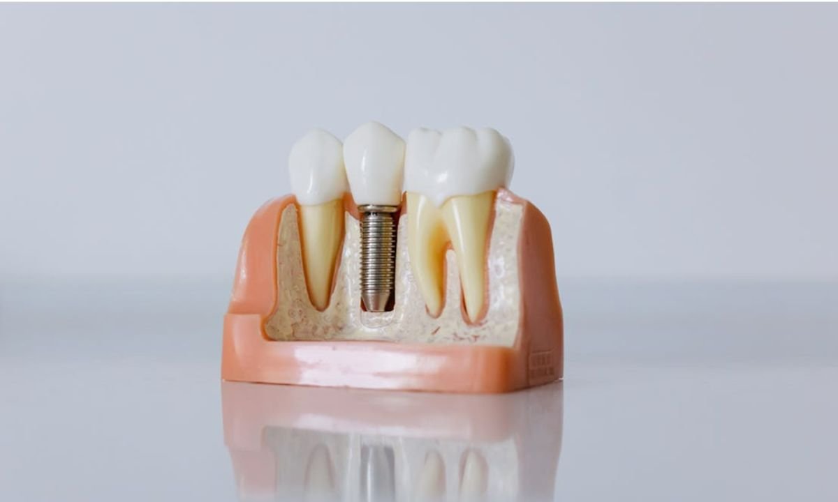 Same-Day Implant Procedures