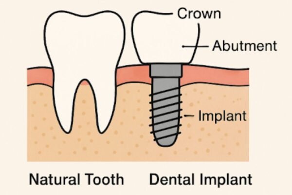 Dental Implant