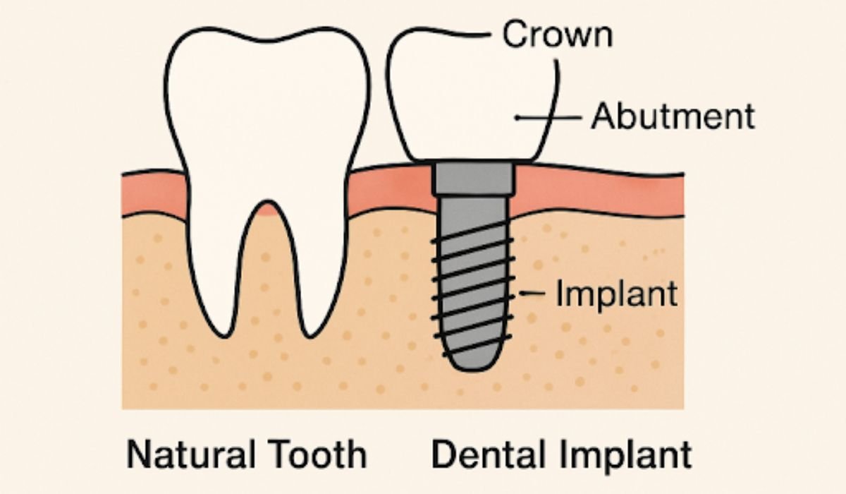 Dental Implant
