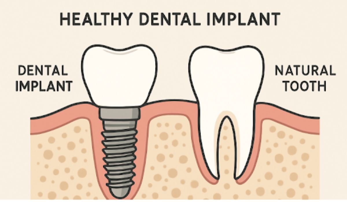 Dental Implant